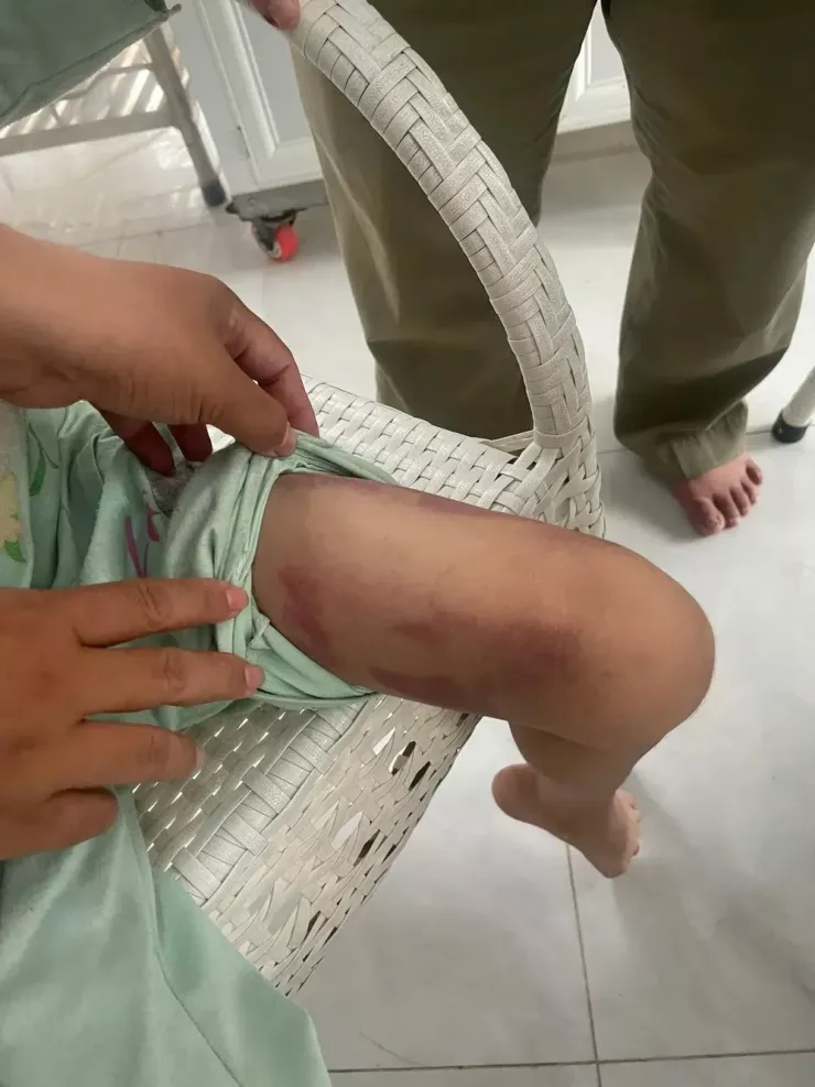 Bé MT và những dấu vết bị bạo hành.